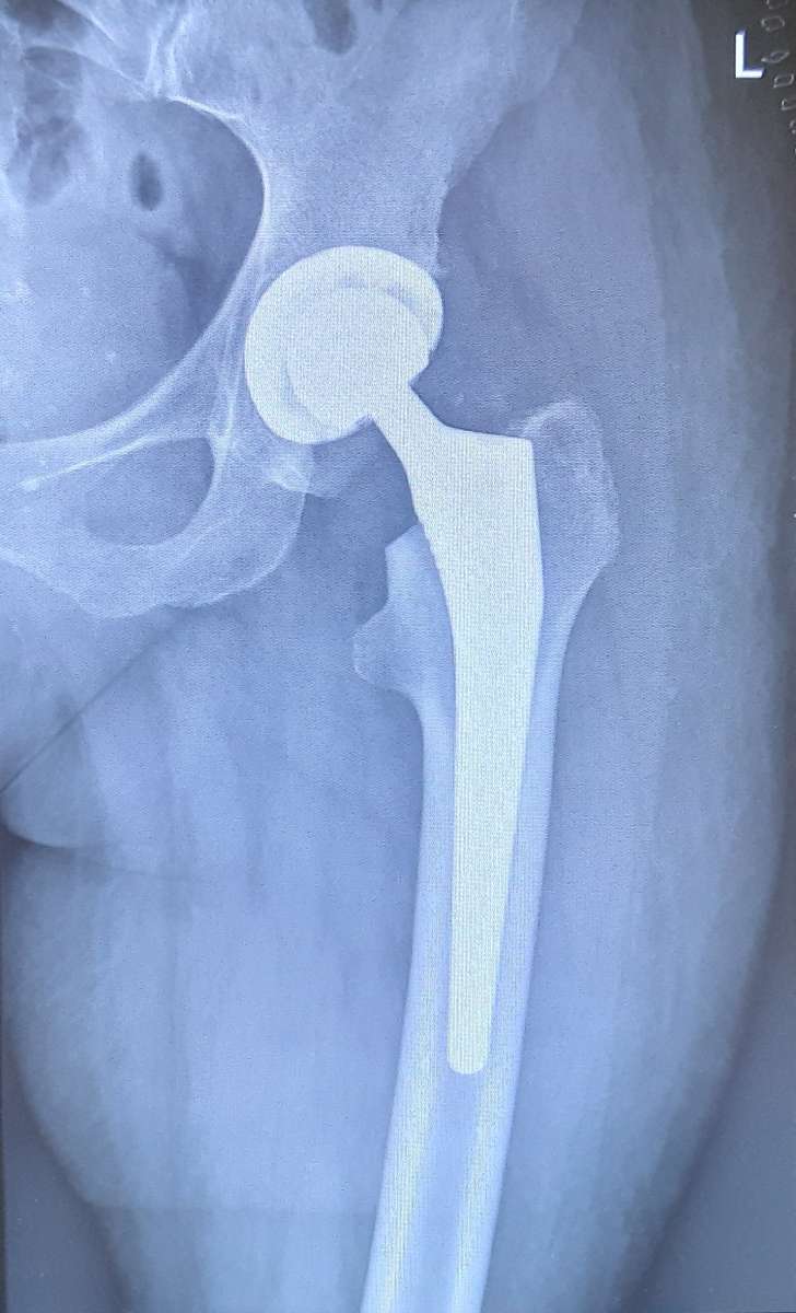 Coxarthrose - Hüftprothese