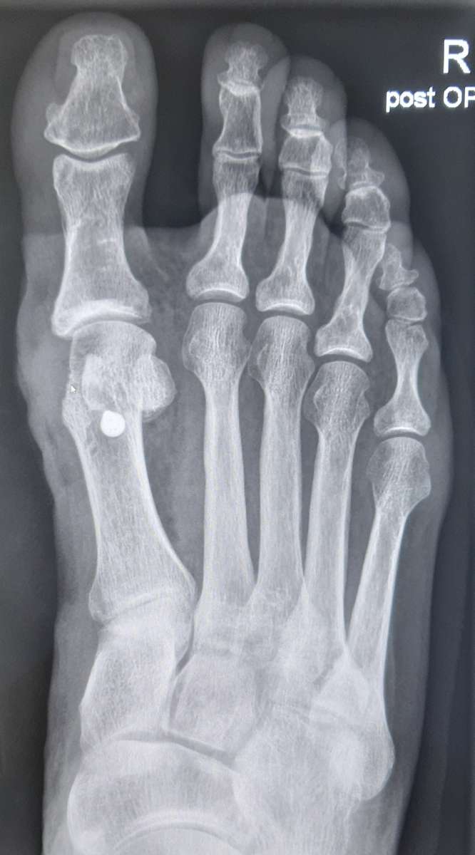 Hallux Valgus